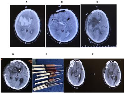Clinical Characteristics of Hydrocephalus Following the Treatment of Pyogenic Ventriculitis Caused by Multi/Extensive Drug-Resistant Gram-Negative Bacilli, Acinetobacter Baumannii, and Klebsiella Pneumoniae